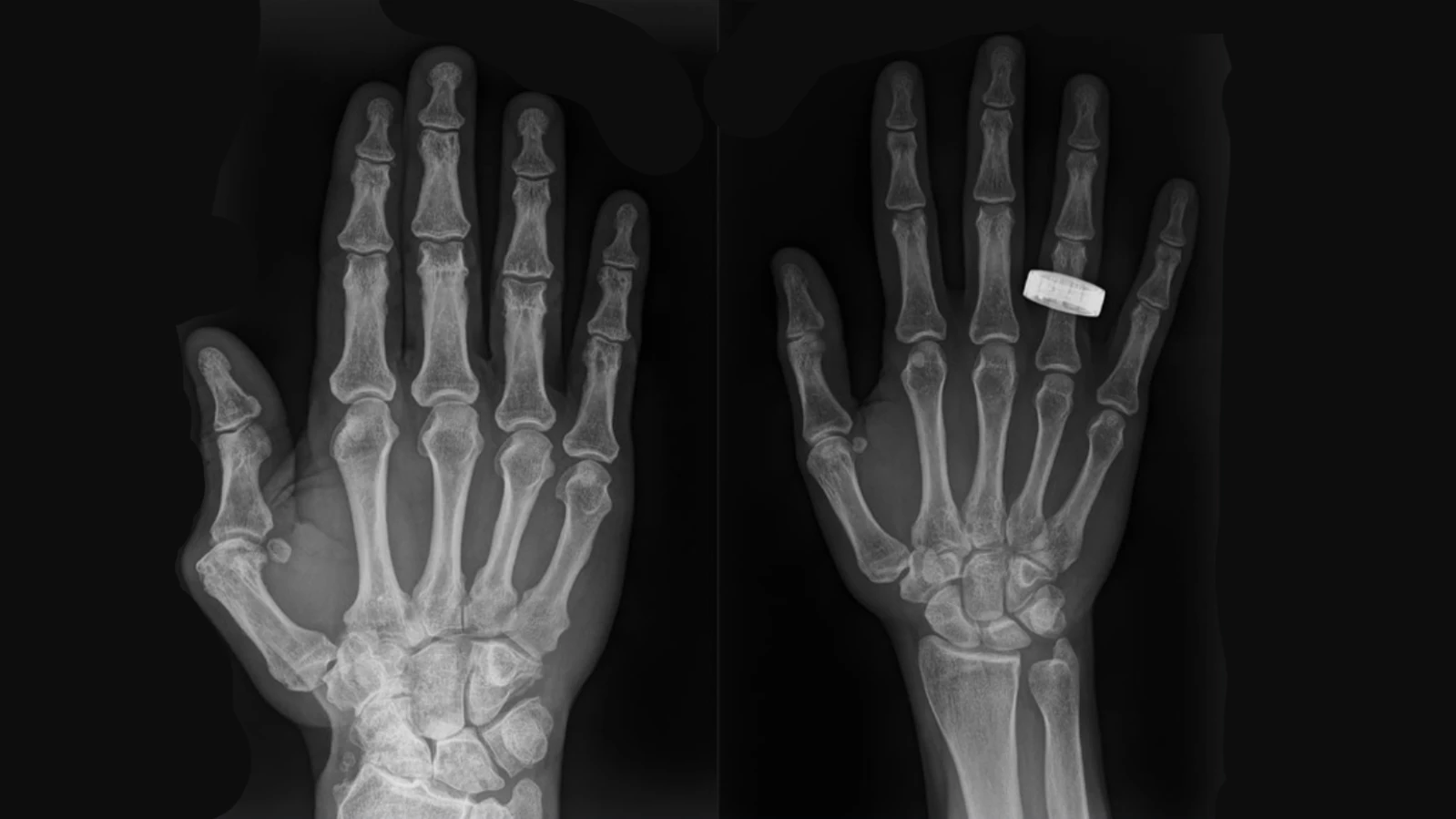 Radiografias no espaço: primeiras imagens humanas feitas em órbita