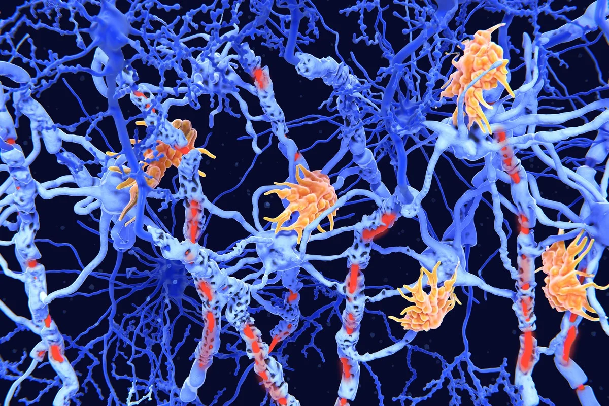 Ocrevus e Novas Terapias: Avanços Promissores em Doenças Neuroimunológicas