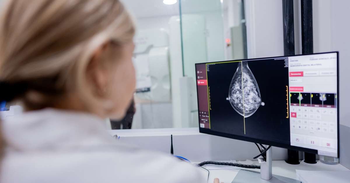 Câncer de mama: inteligência artificial revoluciona a detecção precoce em exames